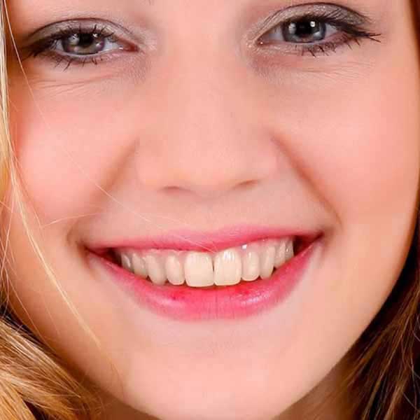 Sonrisa antes del tratamiento estético