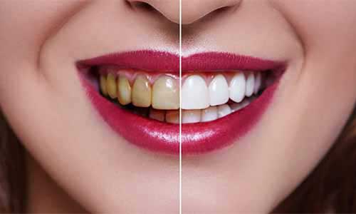 Blanqueamiento dental