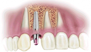 Implantes dentales