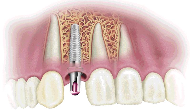 Implantes dentales