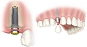 implantes-dentales1