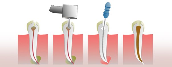 Todo sobre la endodoncia 