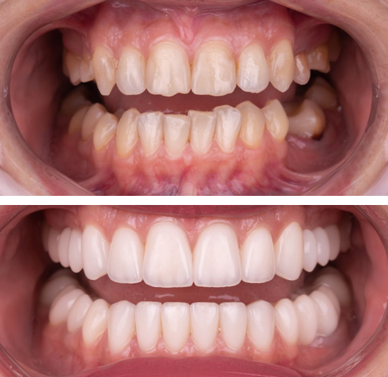 Blanqueamiento dental en valencia