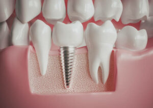 implantes dentales en ruzafa