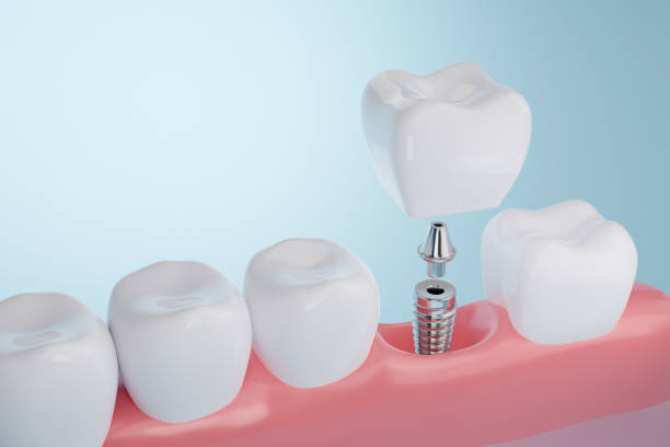 Implantes dentales