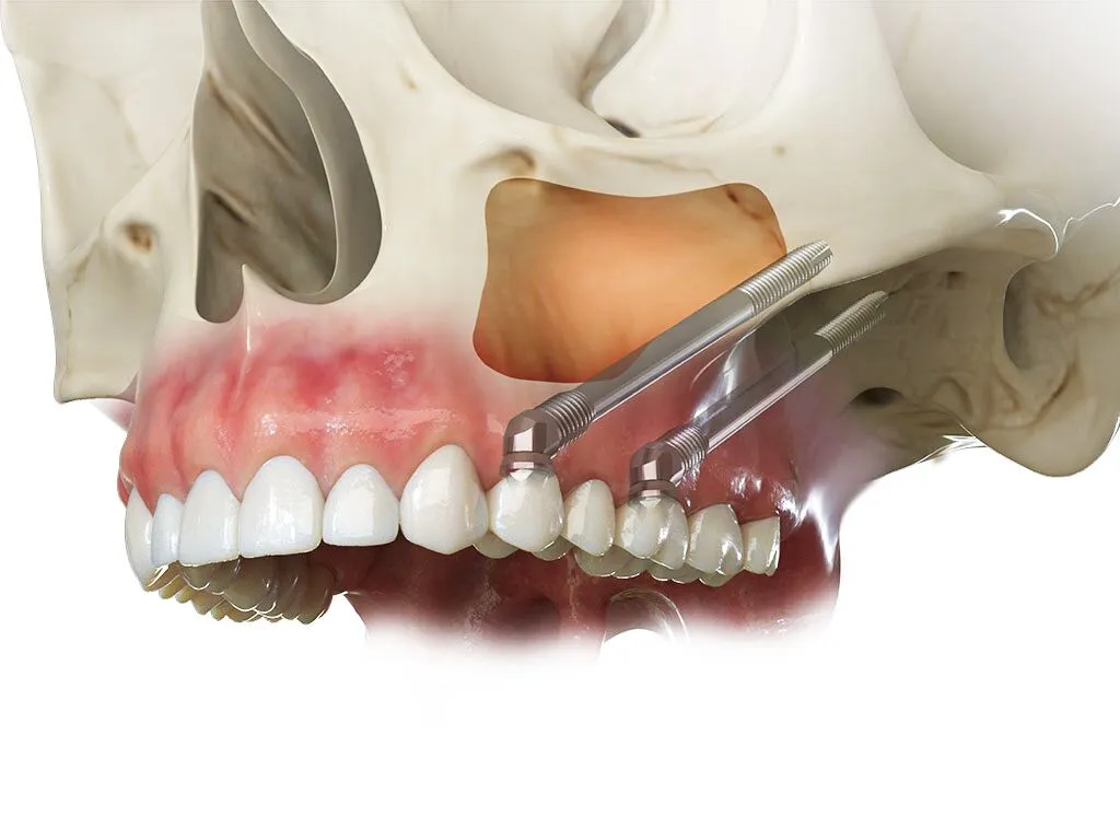 implantes dentales cigomáticos