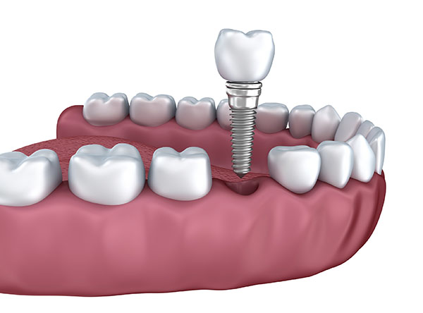 implantes dentales con tornillos