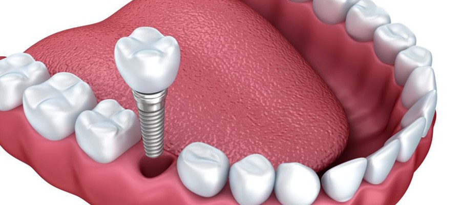 implantes dentales de carga inmediata