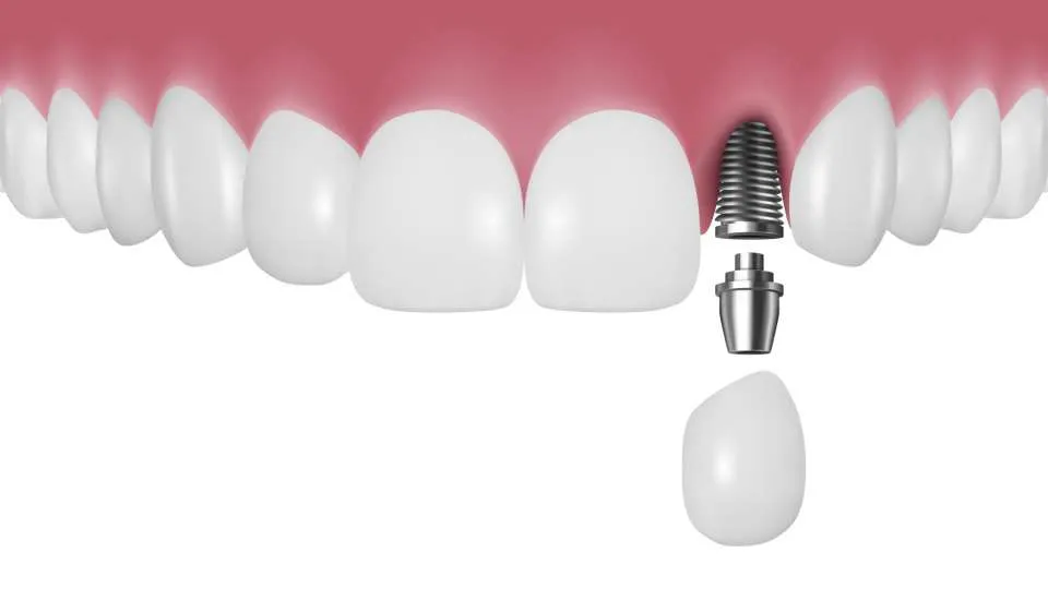 Implantes dentales monofásicos