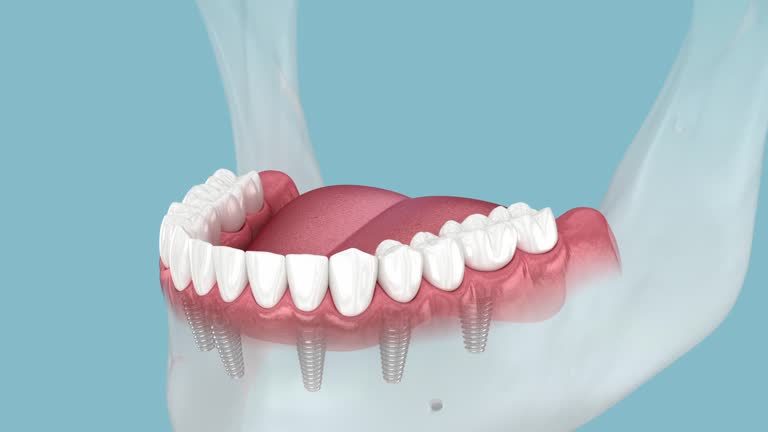 Implantes dentales all on four