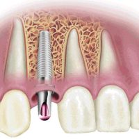 Implantes dentales