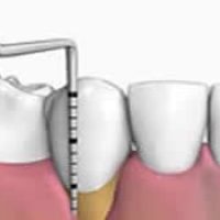 Periodoncia